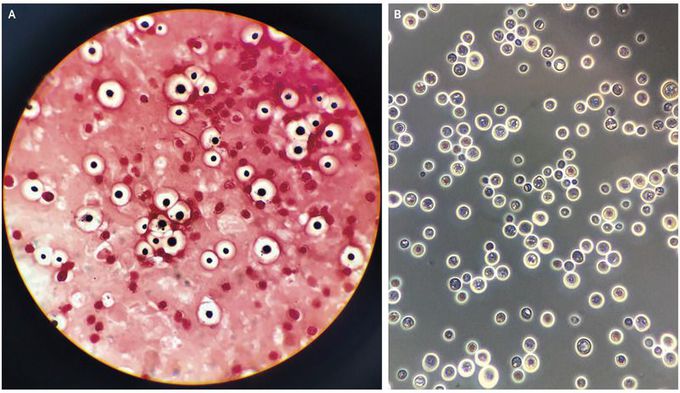 Cryptococcus neoformans Meningoencephalitis