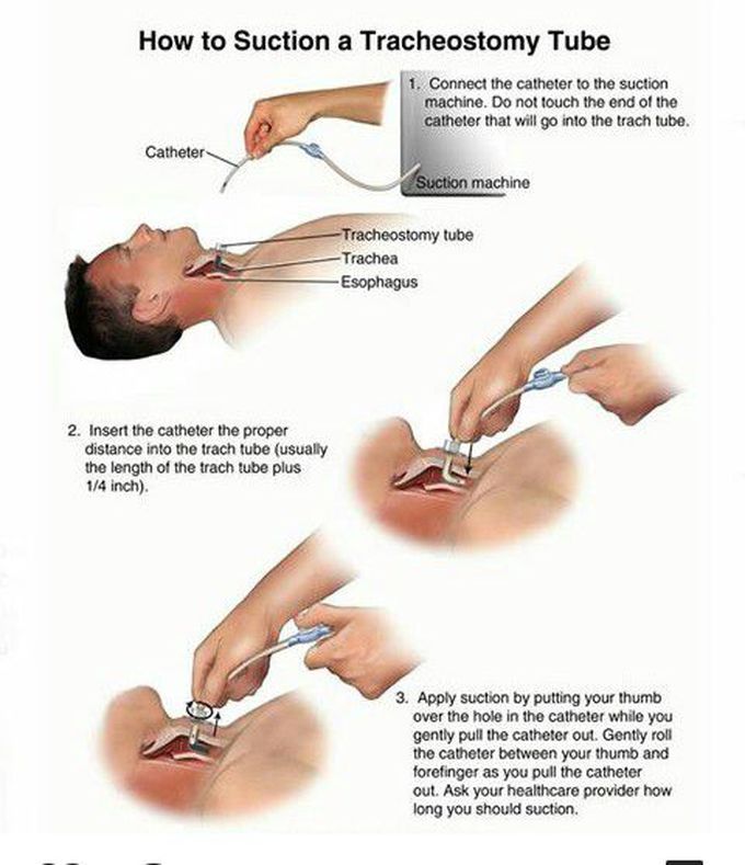 How to suction a Tracheostomy Tube