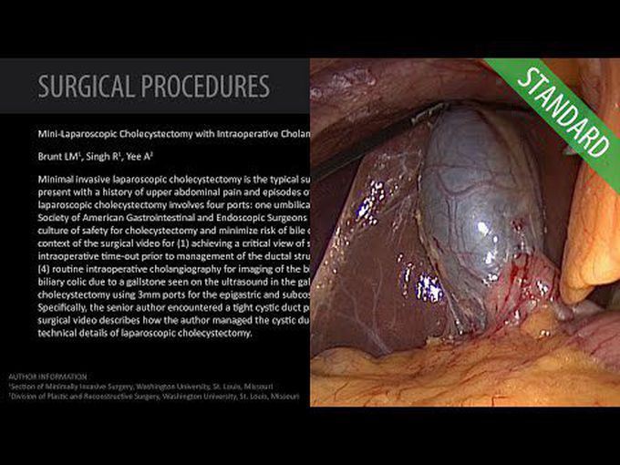 Laparoscopic cholecystectomy-Surgical treatment 
of gallstones