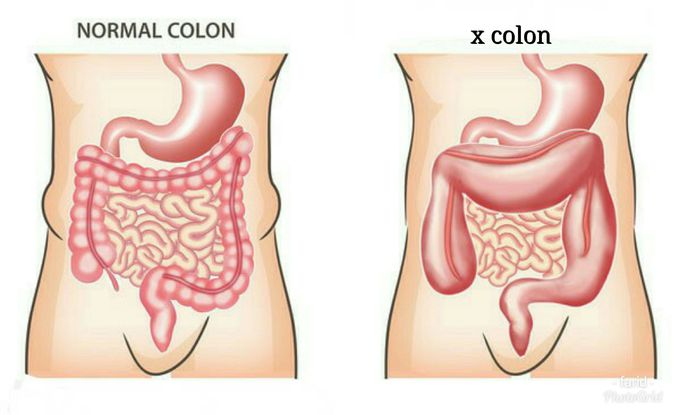 What's the name of this type of colon??and why it happen??