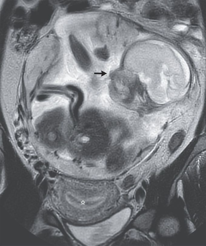 Abdominal Ectopic Pregnancy Medizzy