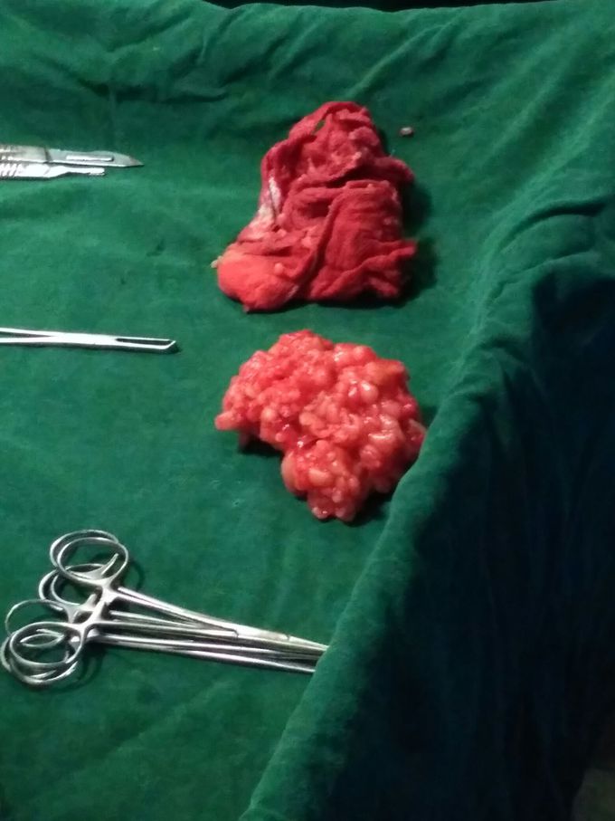 Lipoma excision surgery