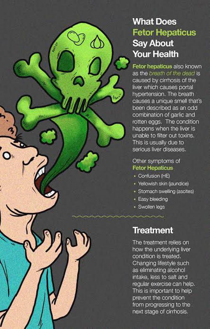 Treatment of fetor hepaticus