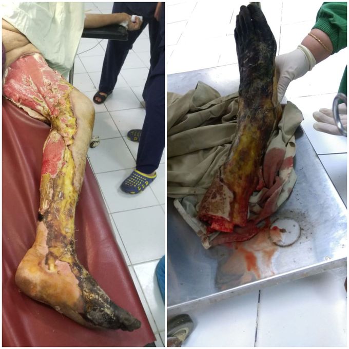 Diabetic foot