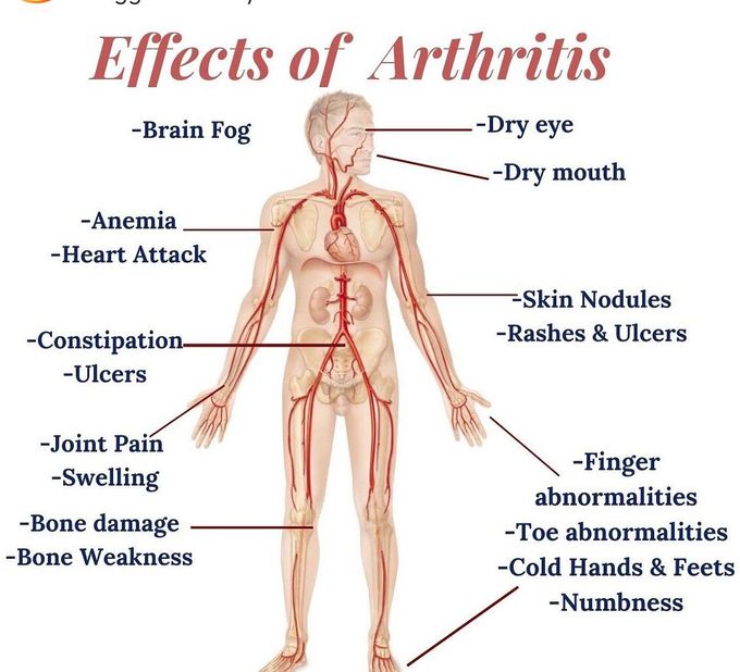 Effects of Arthritis