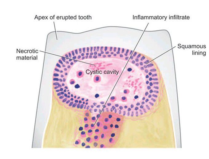 Dental (Radicular) cyst.