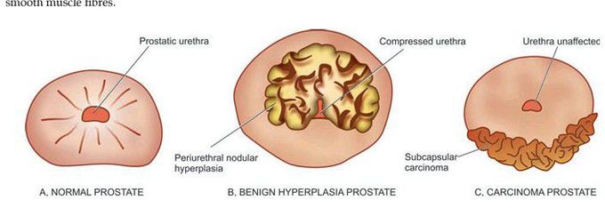 Prostate pathology