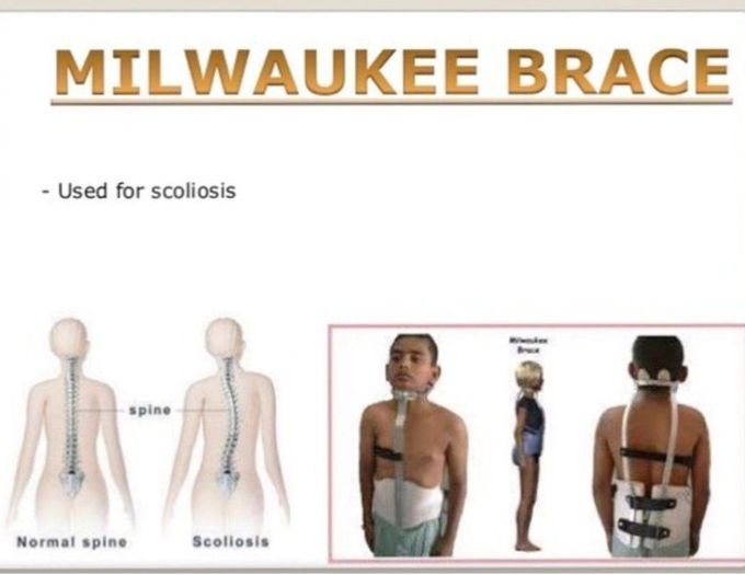 Milwaukee Brace