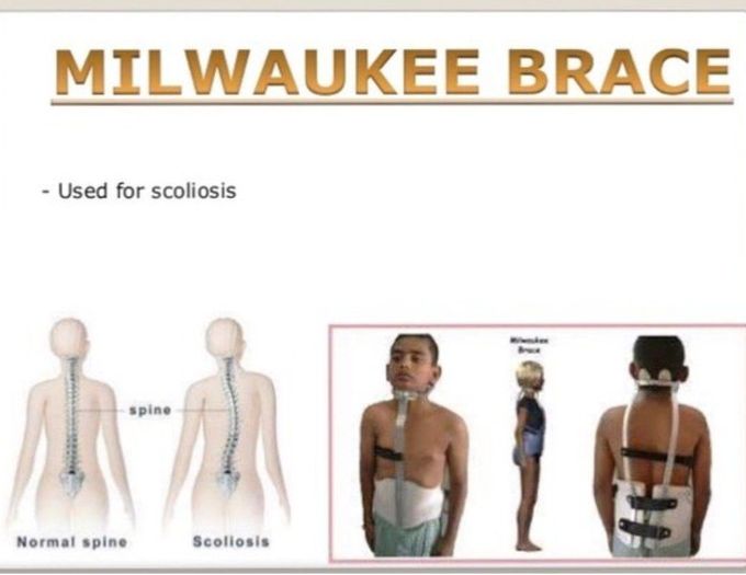 Milwaukee Brace