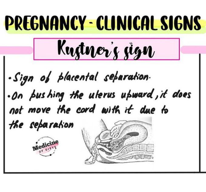 Kustner's sign