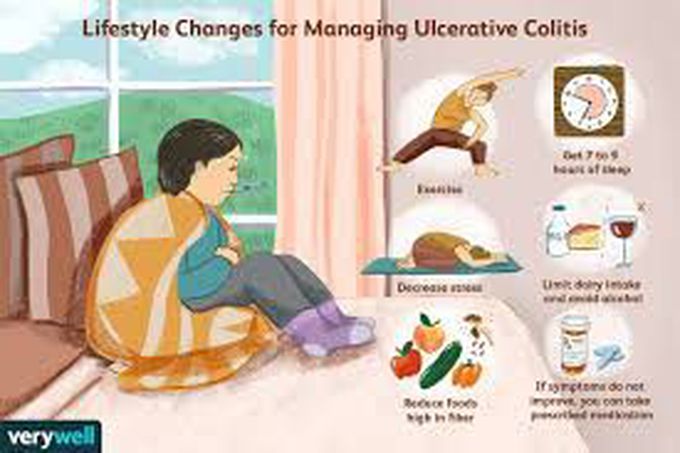 Treatment of ulcerative colitis