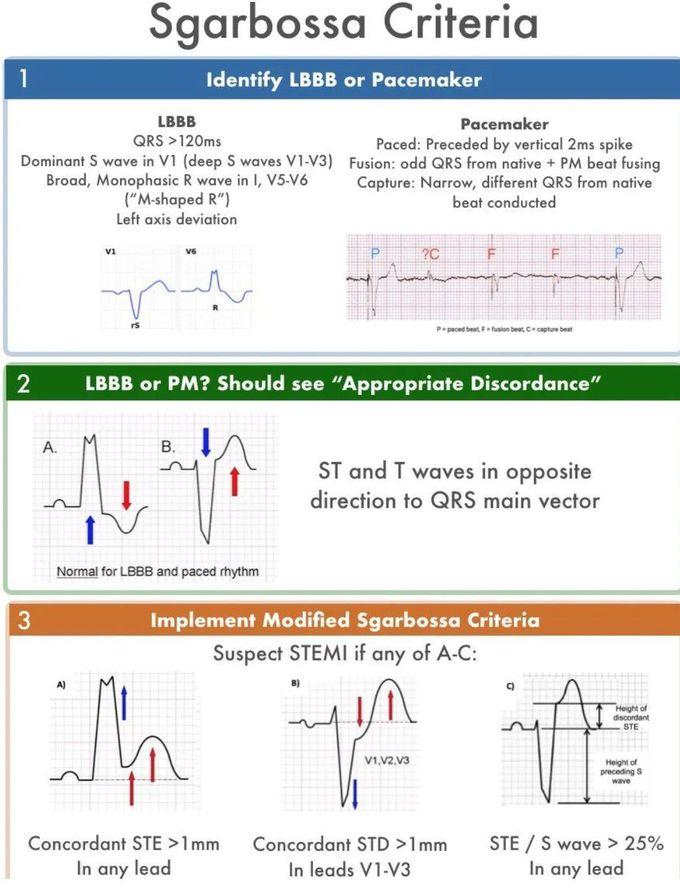 Sgarbossa Criteria