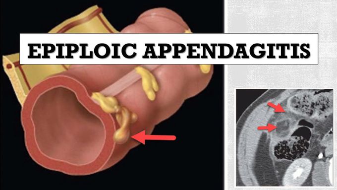 Epiploic Appendagitis