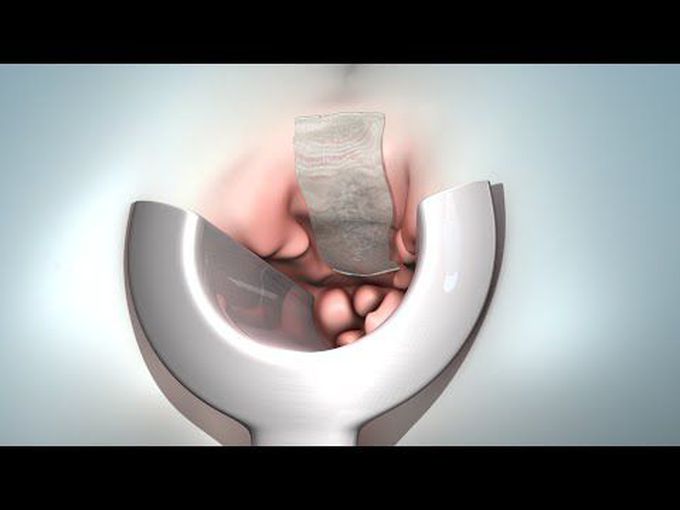 Hemorrhoid Removal: 3D Animation