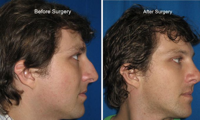 Reduction Rhinoplasty