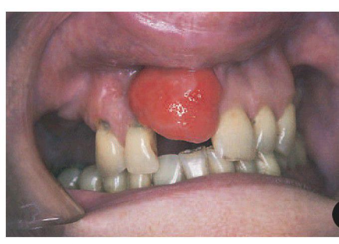 Pyogenic granuloma