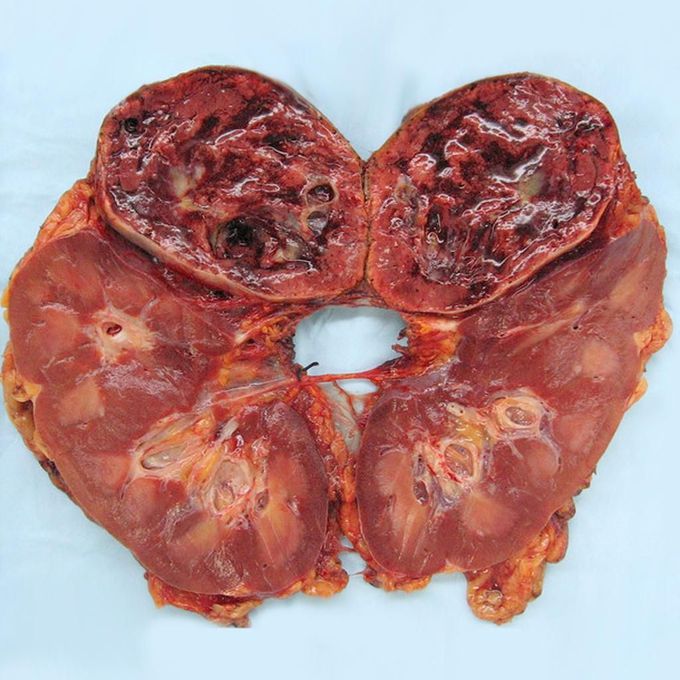 Pheochromocytoma