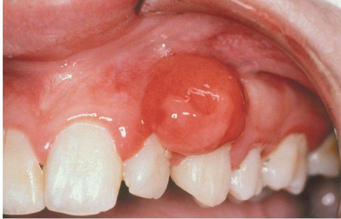 Peripheral Ossifying Fibroma