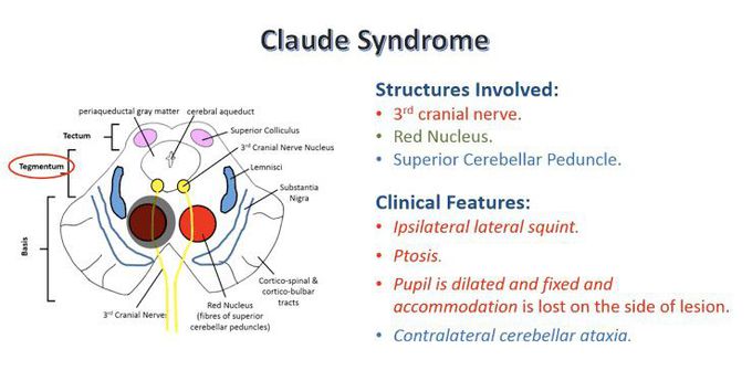 These are the clinical features of Claud's syndrome