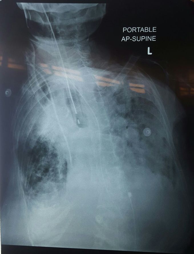 Chest xray interpretation