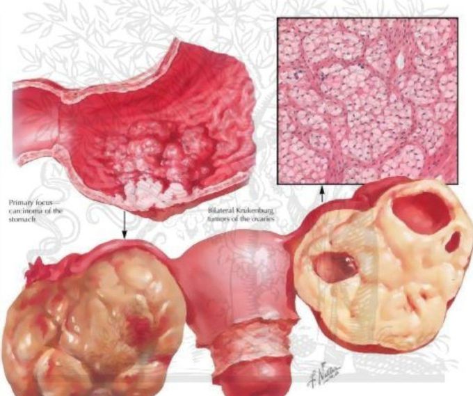 Metastatic  tumor