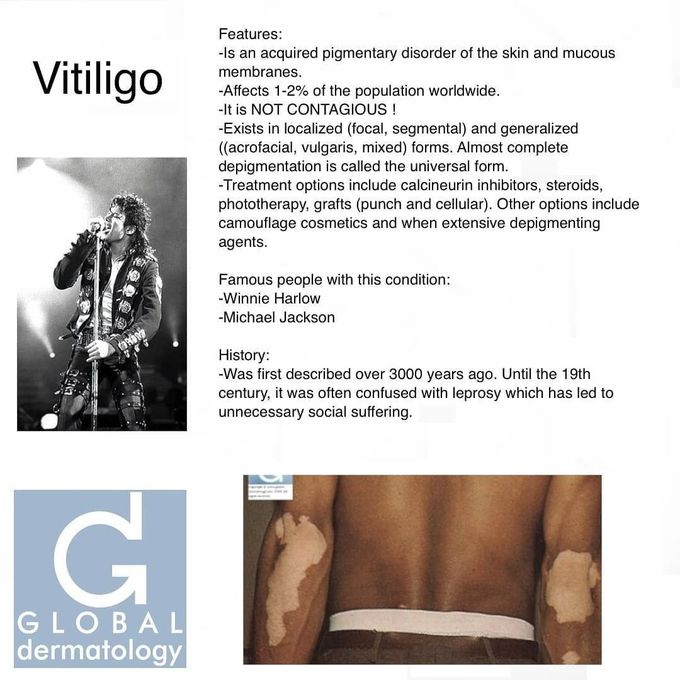 Vitiligo