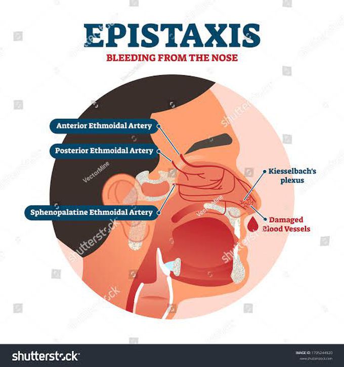 その他 The Nosebleeds How to stop nose bleeding? - MEDizzy