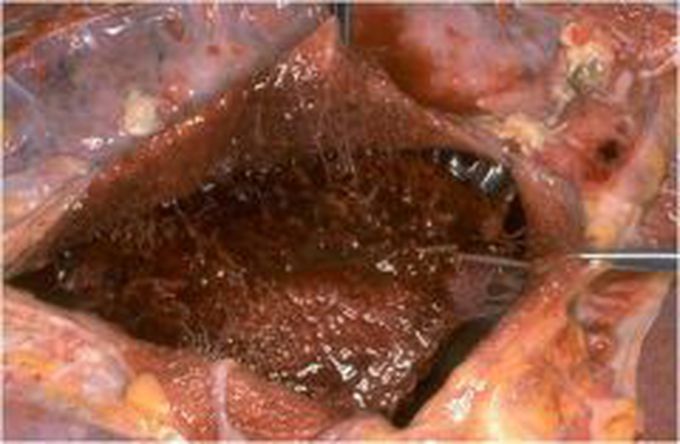 Fibrinous Pericarditis😒😒