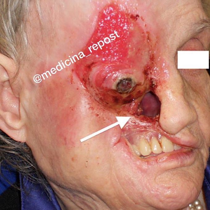 Trigeminal trophic syndrome