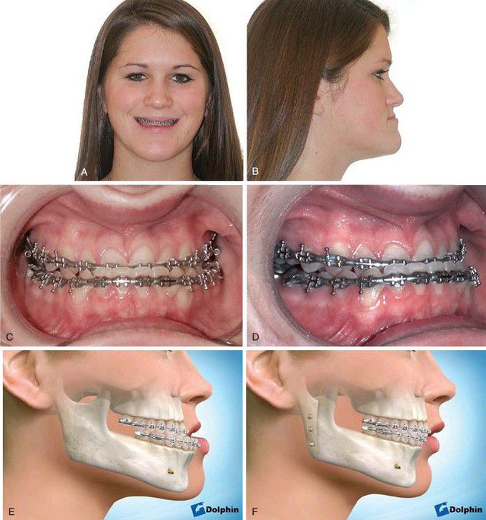 Mandibular excess.