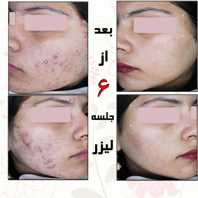 Acne treatments?