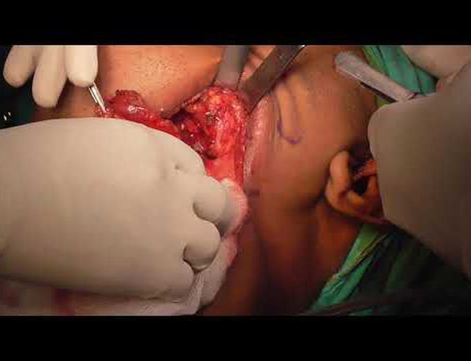 Selective neck dissection