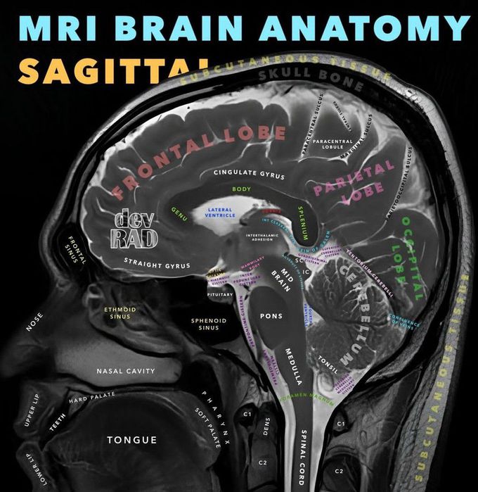 MRI BRAIN