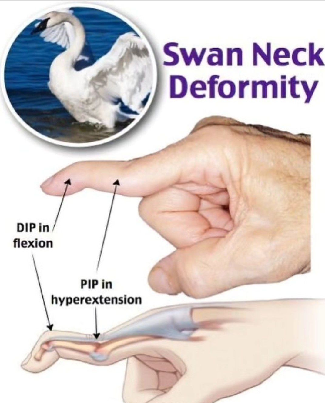 Swan Neck Deformity MEDizzy