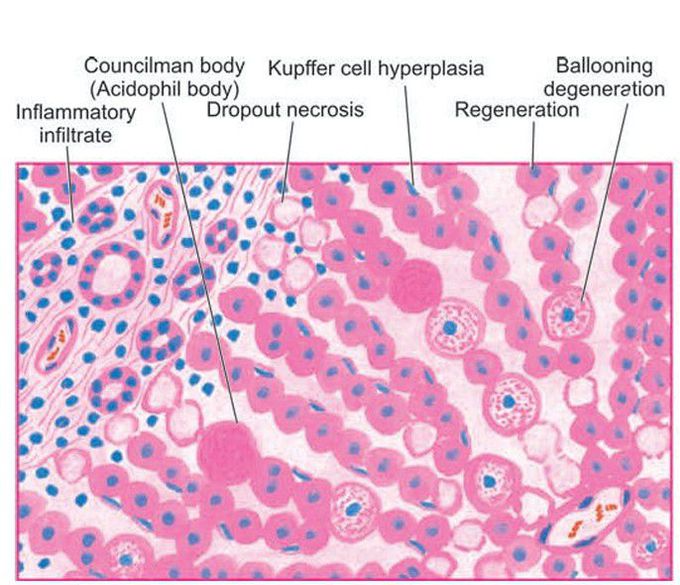 Acute viral hepatitis.