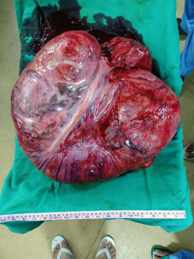 25kg tumor