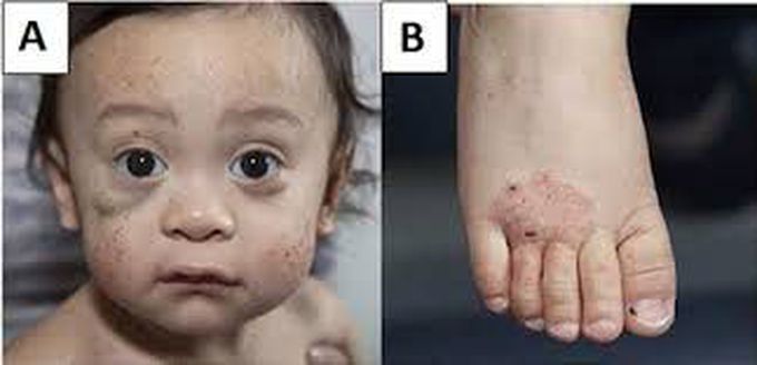 Diagnosis of wiskott aldrich syndrome