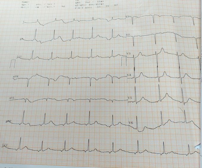 EcG, what is your diagnosis?