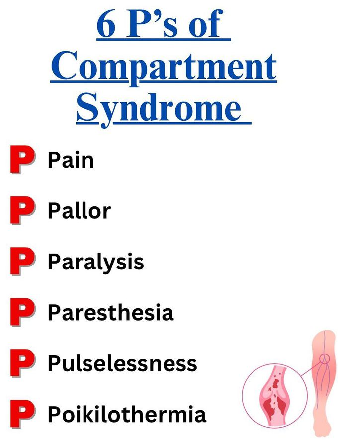 Compartment Syndrome- Mnemonic