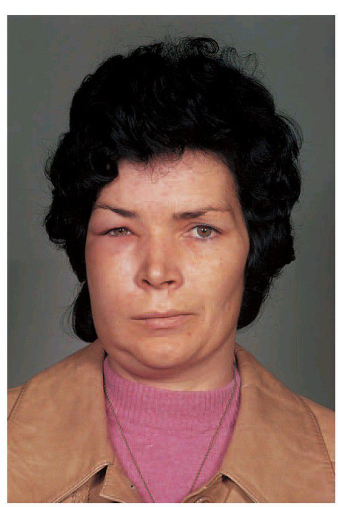 Facial oedema