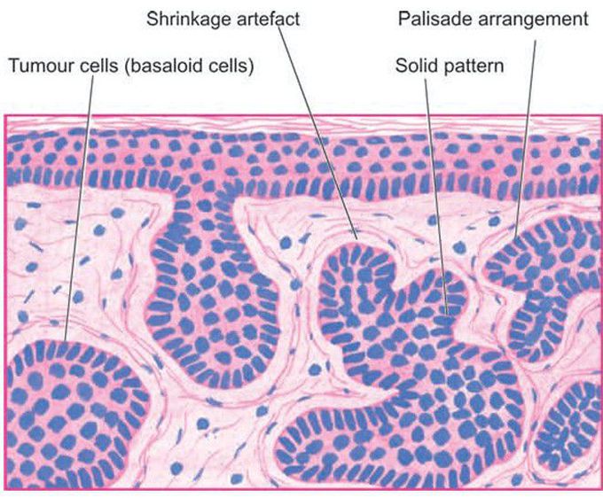 Solid basal cell carcinoma