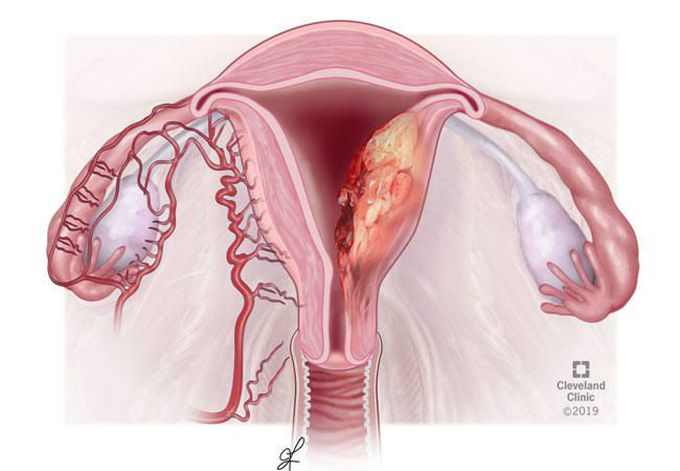 Endometrial carcinoma