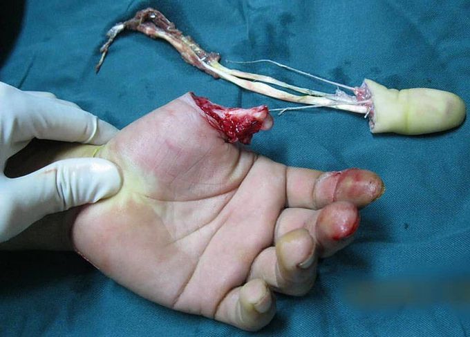 Rotational avulsion of the thumb!! 
