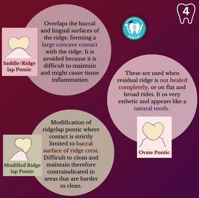 Types of Pontics II