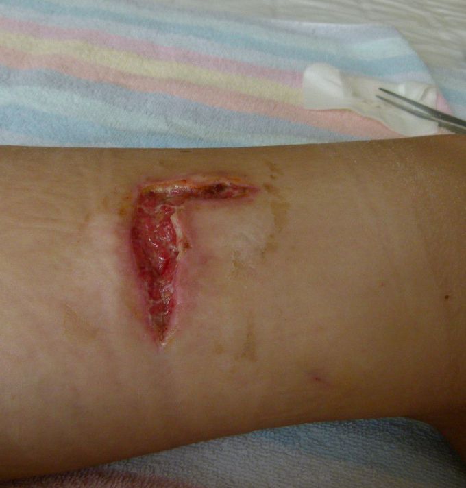Stitches or not