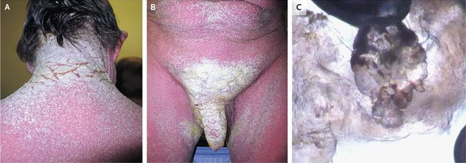 Crusted Scabies