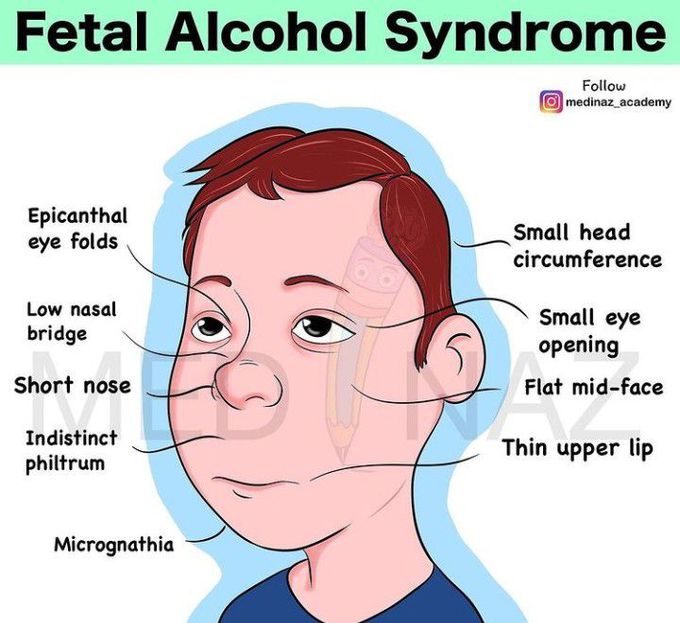 Fetal alcohol syndrome