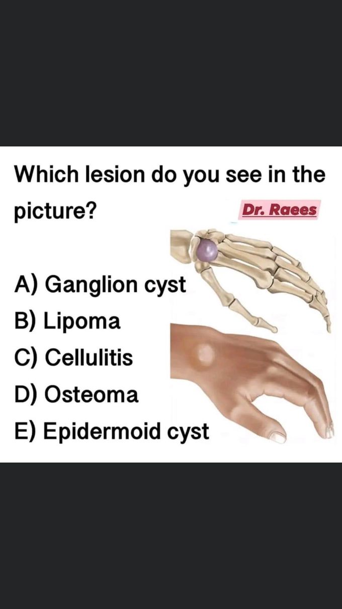 Which lesion do you see in picture?