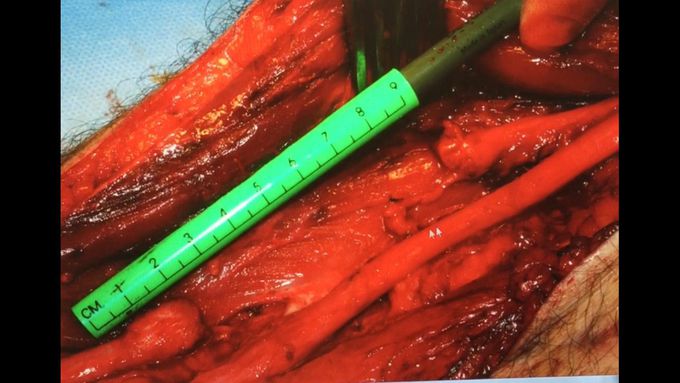 Common peroneal nerve