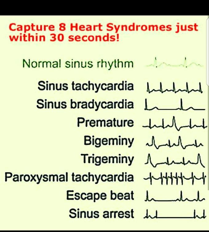 Different Heart rates